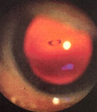 Photo of the Eye Floater